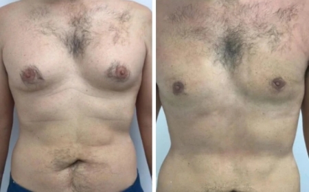 How to Talk to Your Surgeon About Gynecomastia Surgery in Dubai