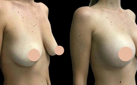 Rediscover Confidence with Breast Augmentation Surgery in Dubai