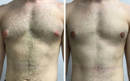 Minimally Invasive Options with the Best Gynecomastia Surgeon in Dubai