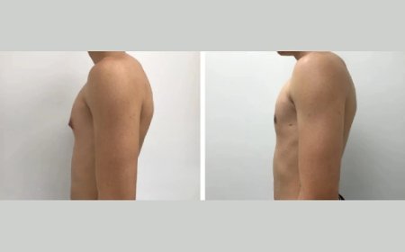 How to Choose a Gynecomastia Surgeon in Dubai with the Best Results