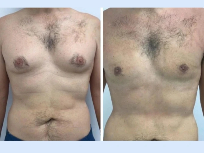 How to Talk to Your Surgeon About Gynecomastia Surgery in Dubai