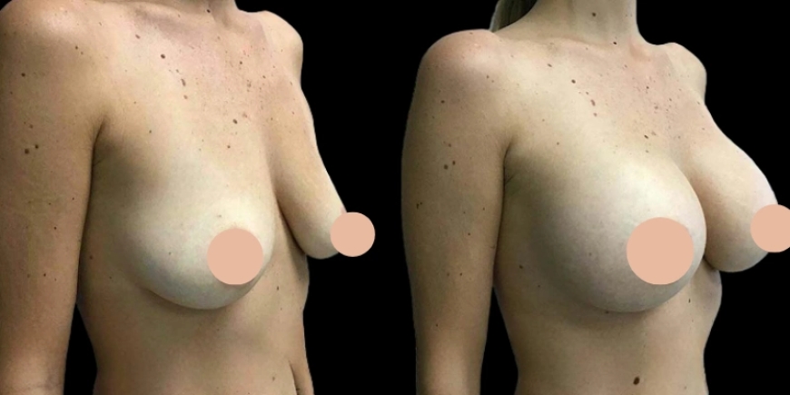 Rediscover Confidence with Breast Augmentation Surgery in Dubai