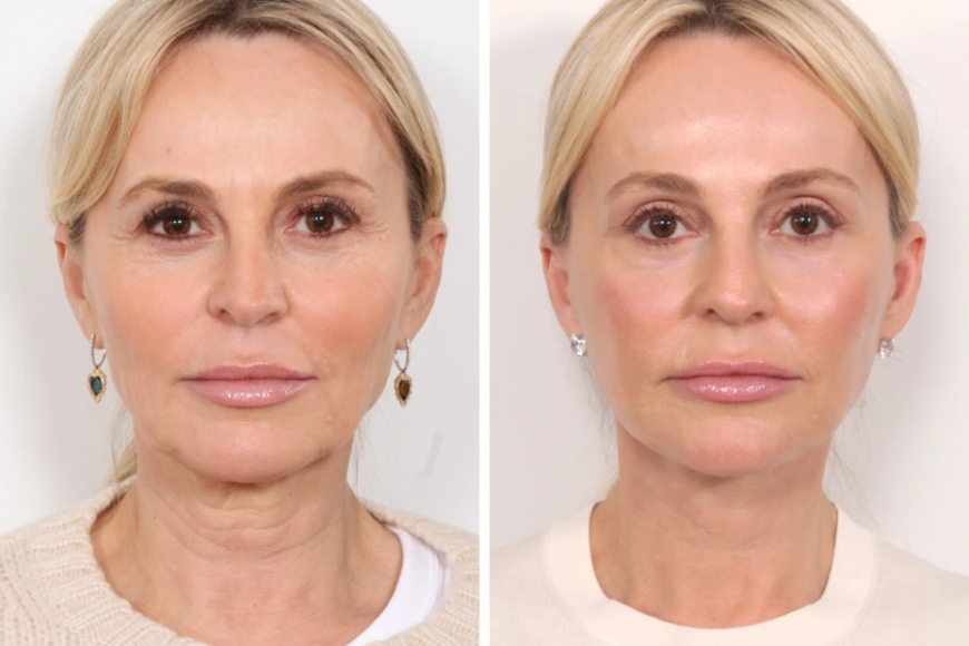 Best Plastic Surgeons in Dubai: Is Thread Lift the Right Solution for You?