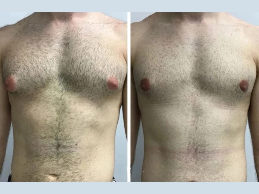 Minimally Invasive Options with the Best Gynecomastia Surgeon in Dubai