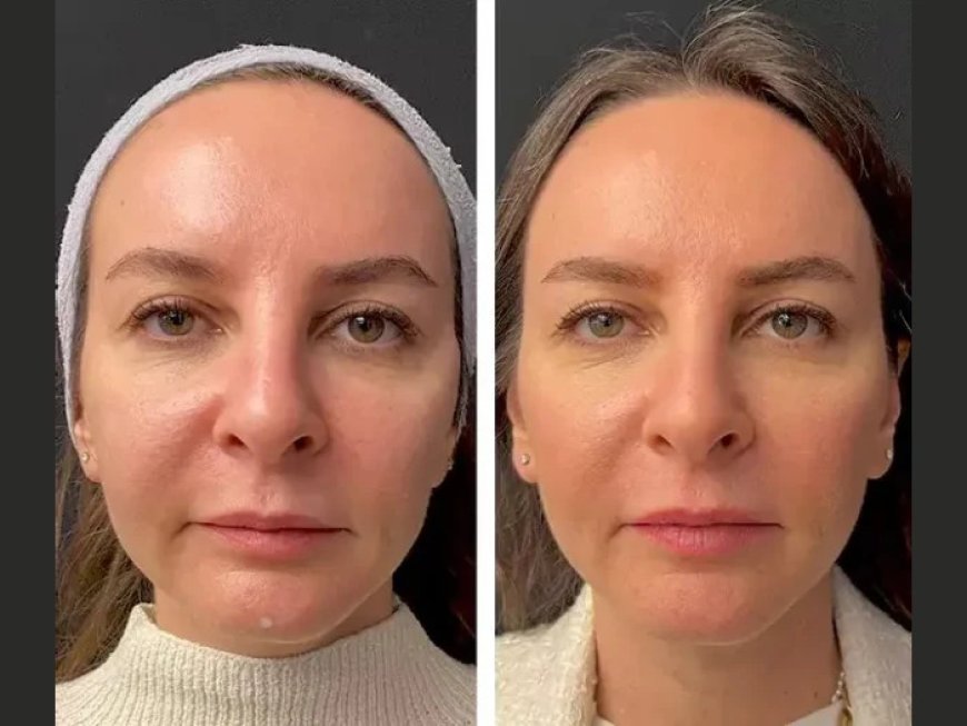 The Best Plastic Surgeon in Dubai Discusses Dutasteride Mesotherapy for Hair Regrowth
