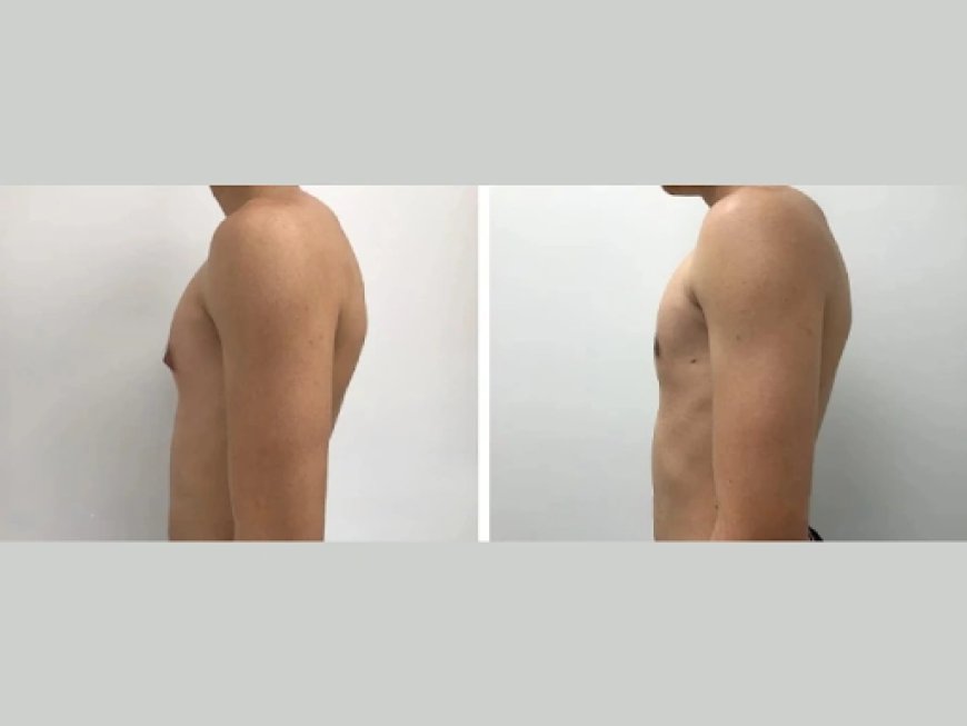 How to Choose a Gynecomastia Surgeon in Dubai with the Best Results