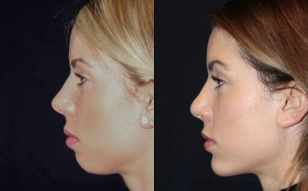 Best Aesthetic Clinic in dubai for Chin Fillers: Safe Practices and Quality Care