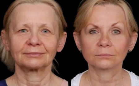 Under Eye Fillers by the Best Doctors in Dubai: Get the Look You Deserve