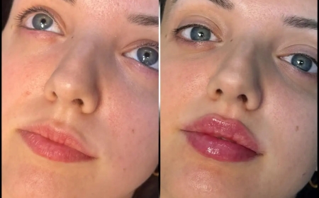 Consult the Best Doctors in Dubai for Fillers and Look Younger