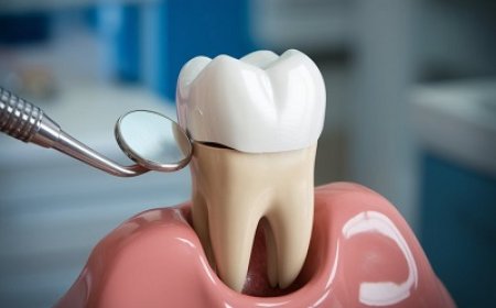 Smile Confidently with Tooth-Colored Dental Crowns