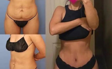 How the Best Tummy Tuck Surgeons in Dubai Use Advanced Techniques for Precision