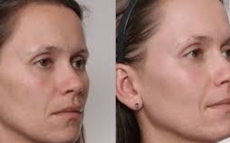 The Gentle Lift: How Laser Skin Tightening Rewinds Time Without Surgery