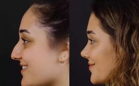 Best Septoplasty Surgeon in Dubai: Award-Winning Expertise