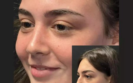 Rebuild Confidence with the Best Rhinoplasty Surgeon in Dubai