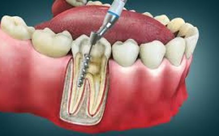 Root Canal Treatment Cost: Your Complete Guide to Affordable Dental Care