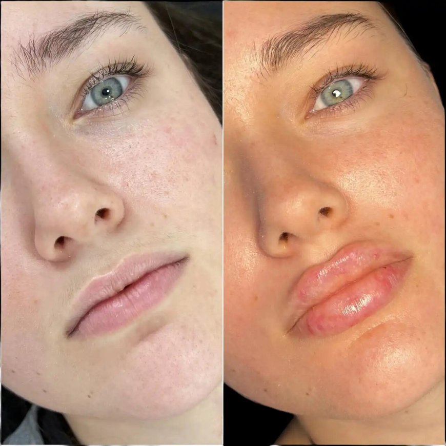 Best Aesthetic Clinic in dubai for Fillers: How to Choose the Right Product