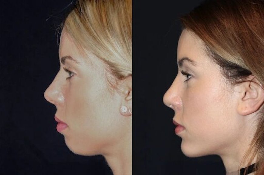 Best Aesthetic Clinic in dubai for Chin Fillers: Safe Practices and Quality Care