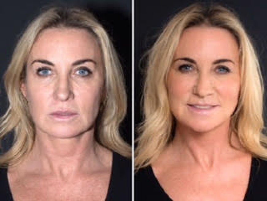 Best Aesthetic Clinics in Dubai Using PDO Threads for Long-Lasting Lifts