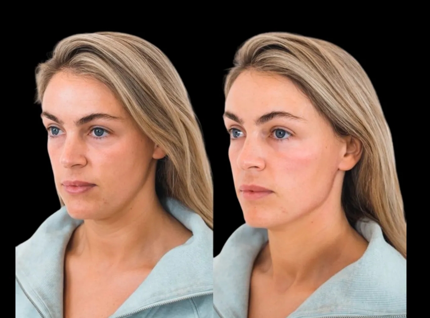 Best Doctors in Dubai: Natural-Looking Cheek Fillers with Expert Care