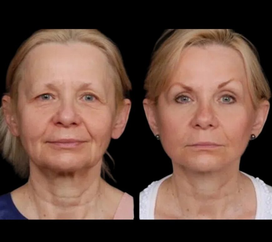Under Eye Fillers by the Best Doctors in Dubai: Get the Look You Deserve