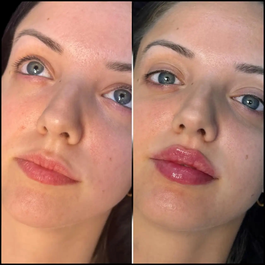 Consult the Best Doctors in Dubai for Fillers and Look Younger