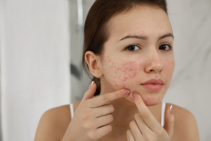 Beyond Creams: Why Dermatology Triumphs in Scar Removal