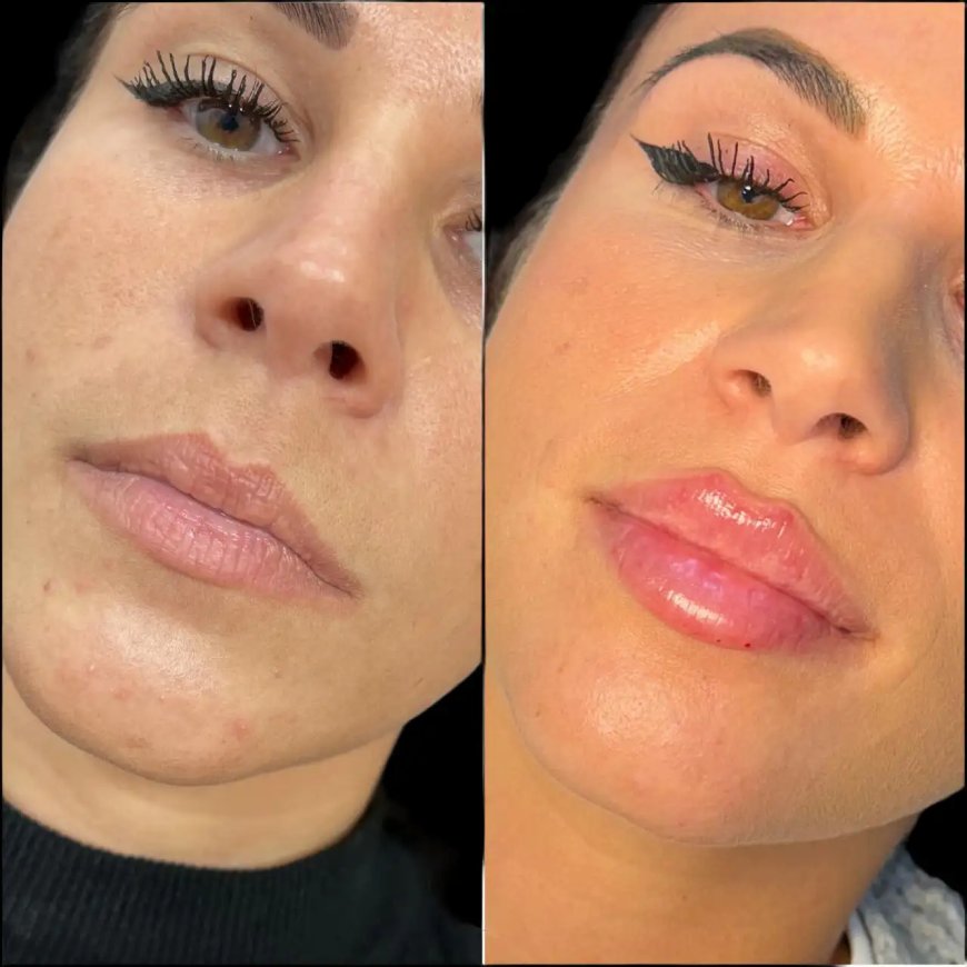 Find the Best Doctors in Dubai for Dermal Fillers and Restored Volume