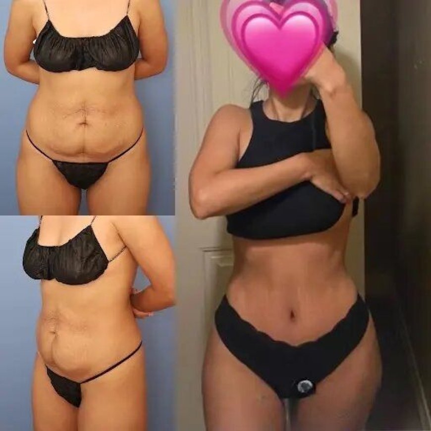 How the Best Tummy Tuck Surgeons in Dubai Use Advanced Techniques for Precision