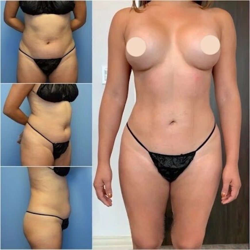 Best Body Contouring Surgeons in Dubai: A Step Toward a Better You