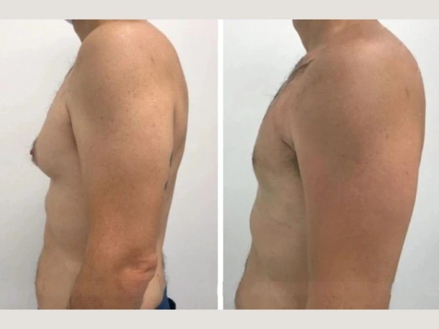 Why You Should Only Trust the Best Gynecomastia Surgeons in Dubai for Your Male Breast Surgery