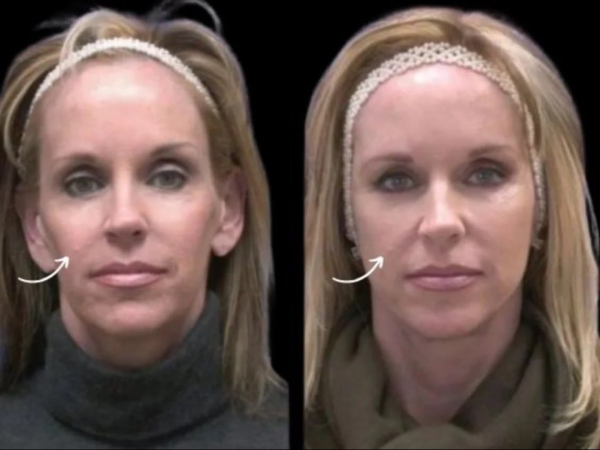 Innovation Hub: Sculptra Fillers R&D at the Best Aesthetic Clinic in Dubai