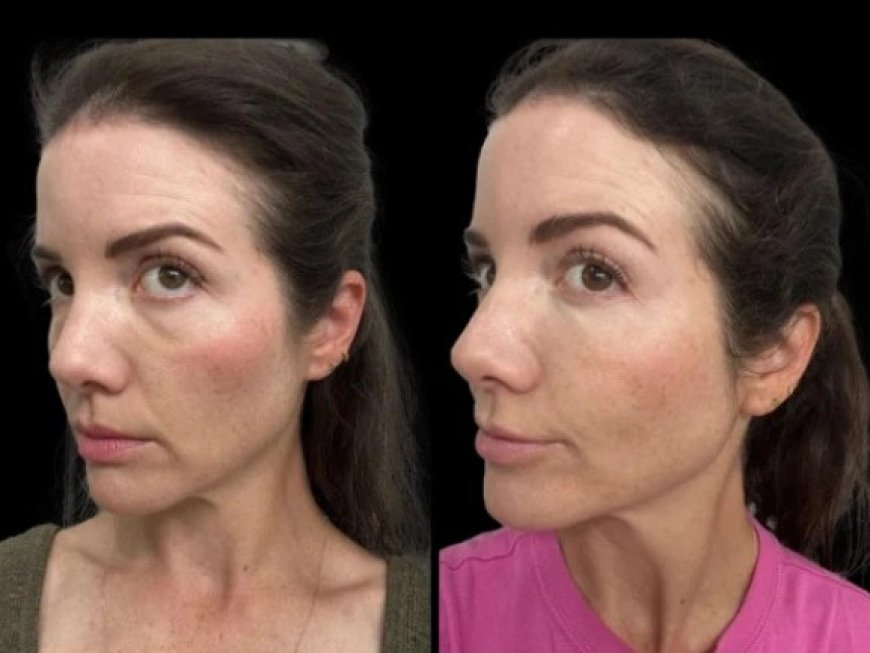 Best Aesthetic Clinics in Dubai for Dark Circles treatment: Non-Surgical Options That Actually Work