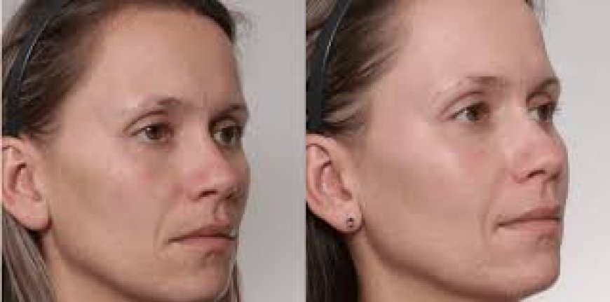 The Gentle Lift: How Laser Skin Tightening Rewinds Time Without Surgery