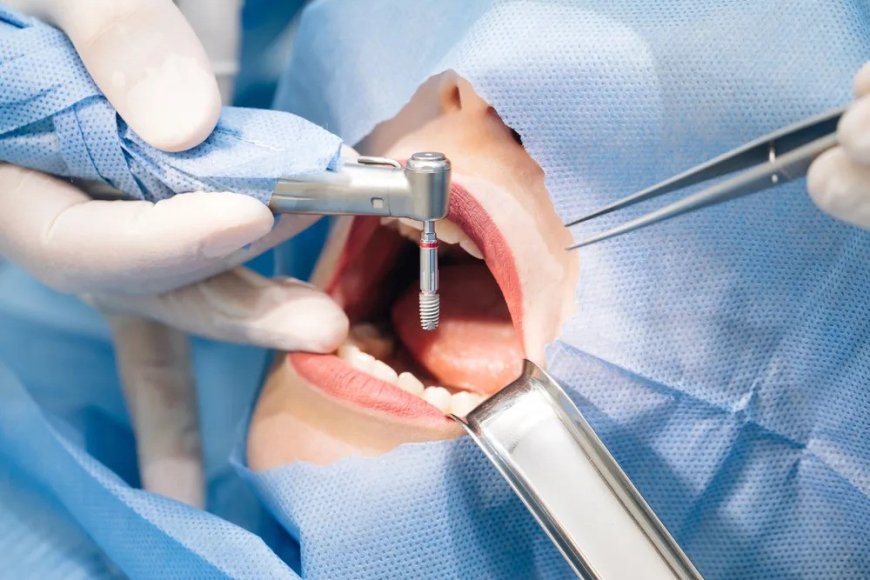 Maintain Facial Structure with Dental Implants