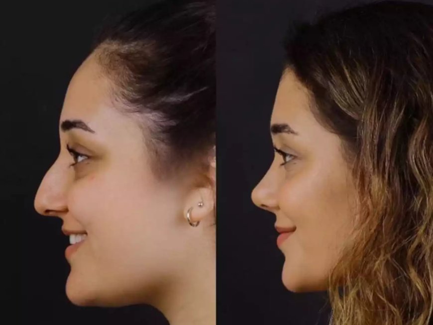 Best Septoplasty Surgeon in Dubai: Award-Winning Expertise