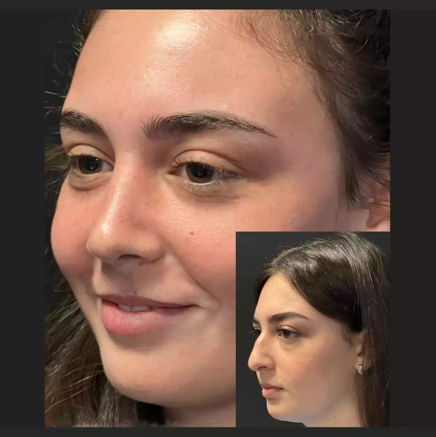 Rebuild Confidence with the Best Rhinoplasty Surgeon in Dubai