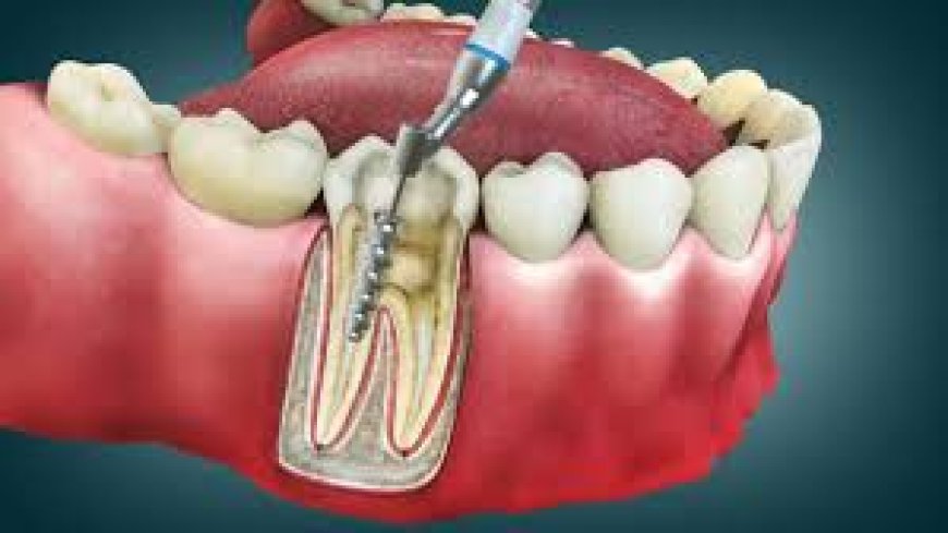 Root Canal Treatment Cost: Your Complete Guide to Affordable Dental Care
