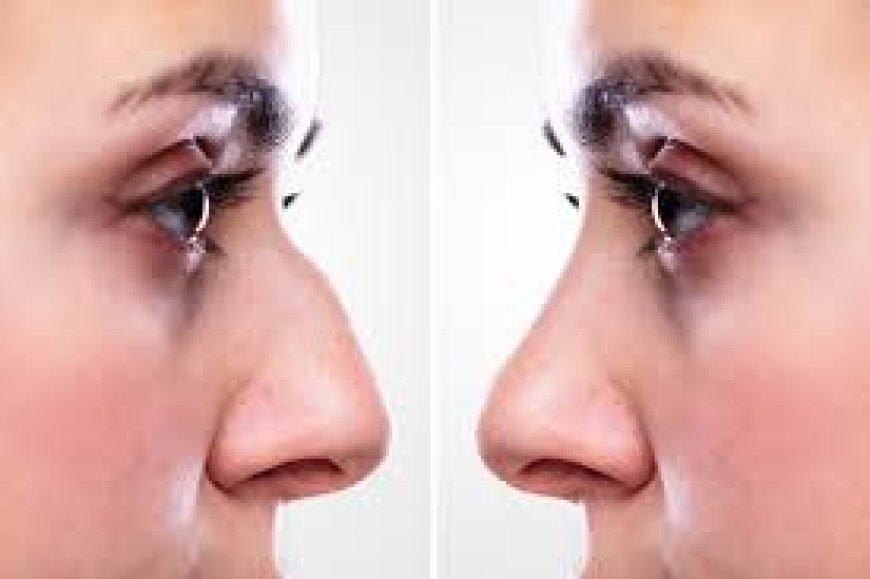 Beyond the Mirror: The Aesthetic and Functional Wonders of Rhinoplasty